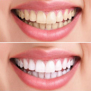 Teeth Whitening Paris 16